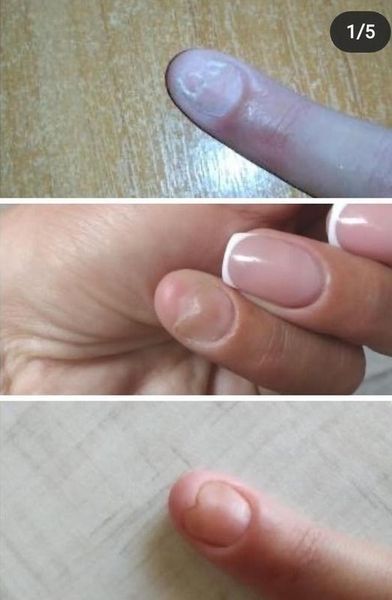 TEYSHA Nail Treat Средство от онихолизиса 10мл 13066 фото